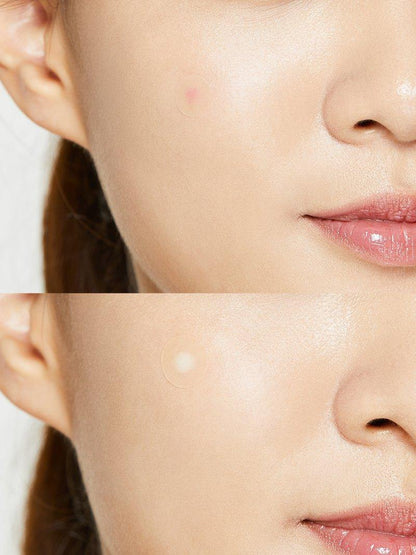 COSRX Acne Pimple Master Patch 24pcs - on-skin application - Korean skincare from 2M Beauty
